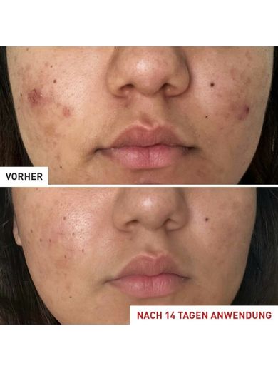 Erborian Centella Acne Care 30 ml